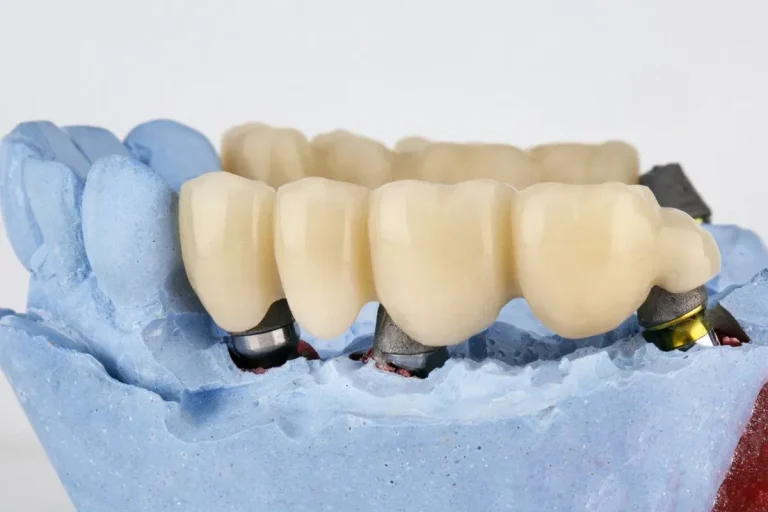 Understanding the Benefits of Crowns and Bridges for Dental Restoration Benefits of Crowns and Bridges for Dental Restoration