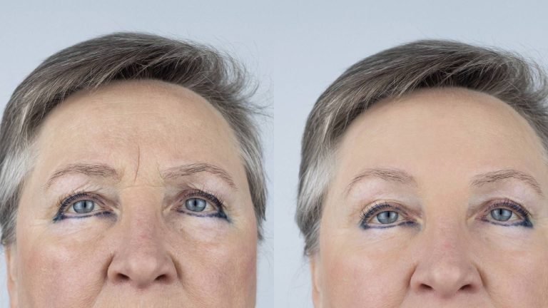 Botox Aftercare