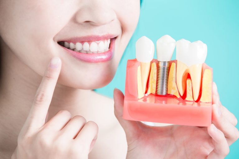 Dental Implant Specialist in Restoring Smiles