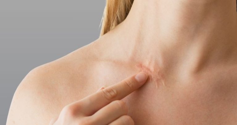 Techniques for Effective Scar Correction and Management Effective Scar Correction