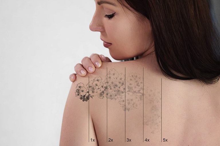 Laser Tattoo Removal