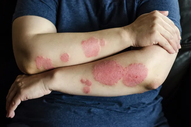 The Role of Dermatology in Managing Chronic Skin Conditions Managing Chronic Skin Conditions