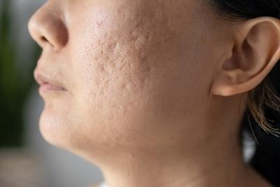 How To Prevent Acne Scarring Prevent Acne Scarring