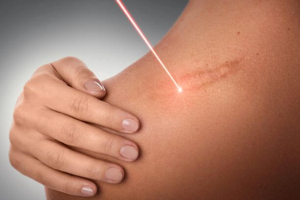 A Guide to Scar Revision Techniques Scar Revision Techniques