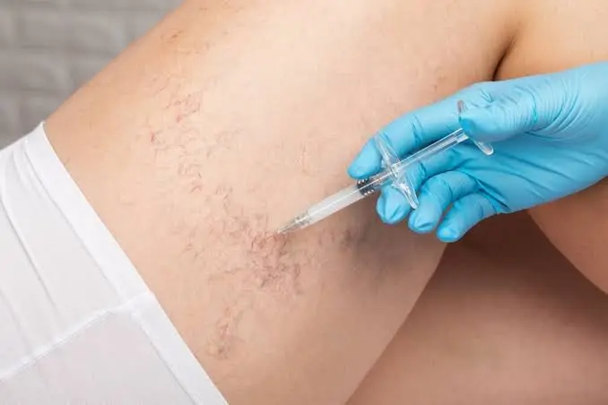 How Sclerotherapy Treats Varicose Veins Sclerotherapy Treats Varicose Veins
