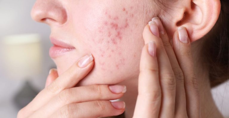 Dermatology’s Role in Treating Acne and Hormonal Changes Treating Acne and Hormonal Changes