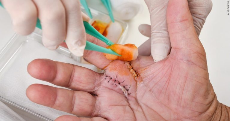Exploring Advanced Techniques in Wound Care Management Wound Care Management