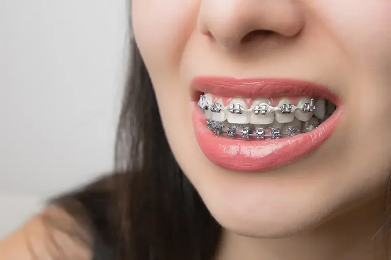 The Pros and Cons of Braces for Adults Braces for Adults