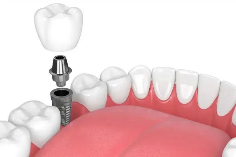 The Role of Dental Implants in Restoring Your Smile Dental Implants in Restoring Your Smile