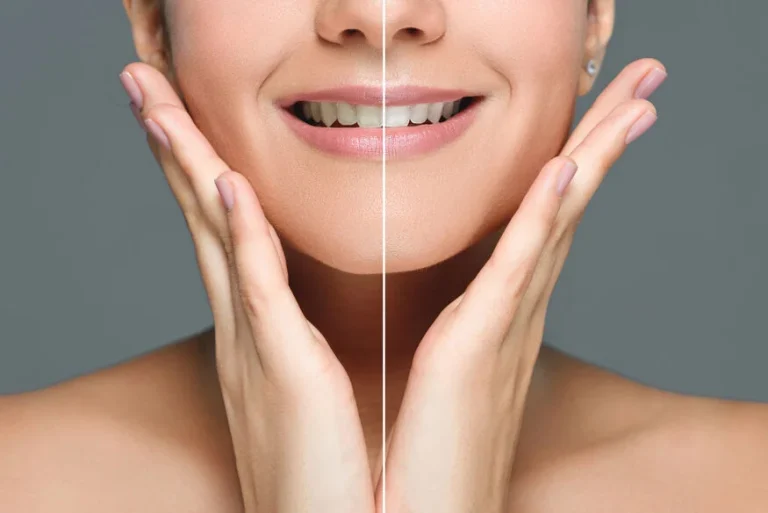 Why Professional Teeth Whitening Supports Long-Term Results Professional Teeth Whitening