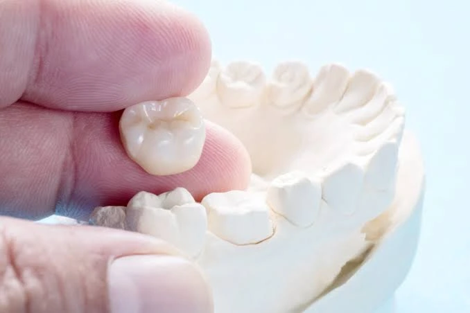 The Process of Getting Dental Crowns Dental Crowns