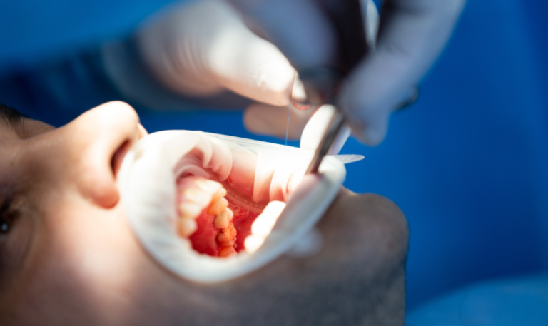 Understanding When You Need Oral Surgery Oral Surgery