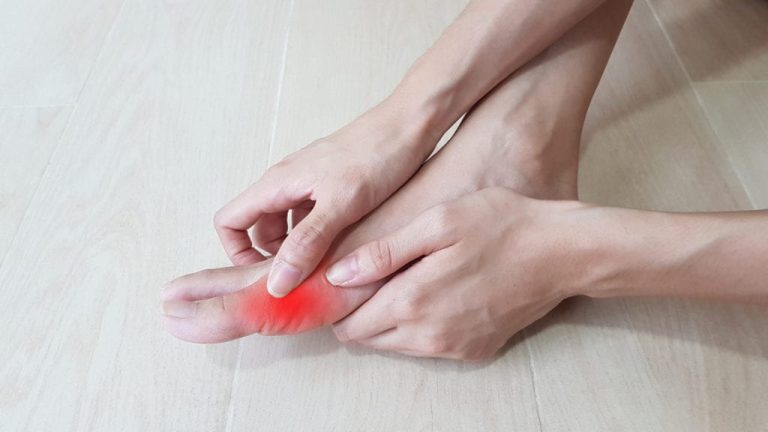 Common Questions and Answers on Bunions Bunions