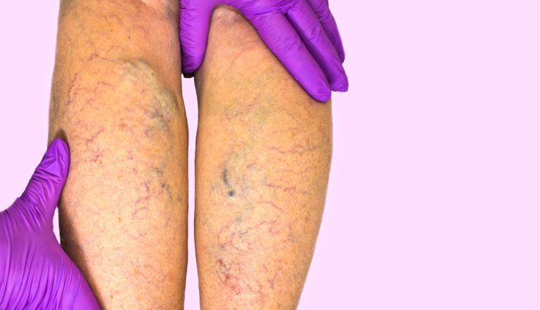 Exploring the Connection Between Chronic Venous Insufficiency and Lifestyle Choices Chronic Venous Insufficiency